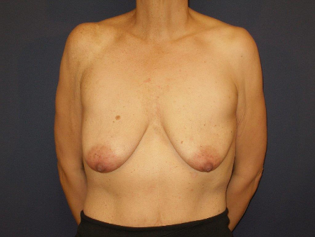 Patient # 84993 Before Photo # 1