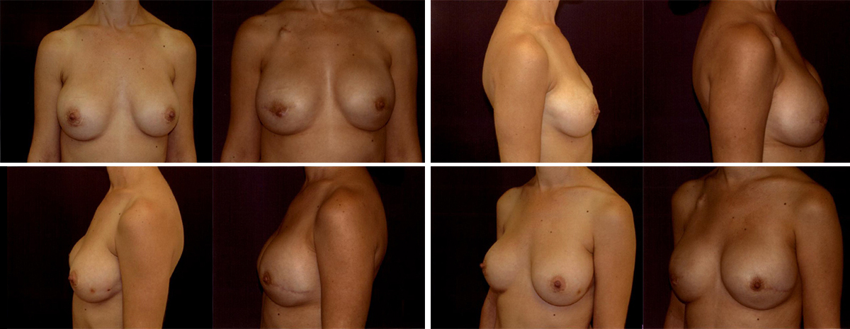 Before and After Image: Patient # 53351 - front