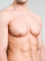 Male Breast Reduction | Gynecomastia | Miami FL | Coral Gables