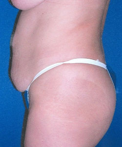 Abdominoplasty Patient 11649 Photo 3