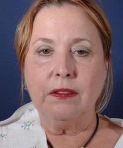 Facelift Patient 92122 Photo 1