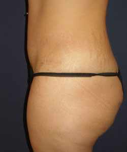 Abdominoplasty Patient 25869 Photo 4