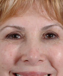 Blepharoplasty Patient 31992 After Photo # 2