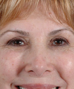 Blepharoplasty Patient 31992 Photo 2