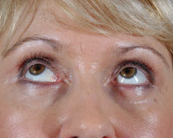 Blepharoplasty Patient 13920 After Photo # 2