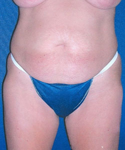 Abdominoplasty Patient 11649 Before Photo # 1