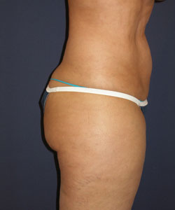 Liposuction Patient 10146 Photo 7