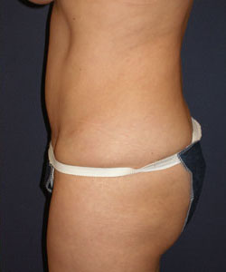 Abdominoplasty Patient 11649 Photo 4