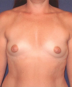 Breast Augmentation Patient 91377 Photo 1