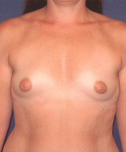 Breast Augmentation Patient 91377 Before Photo # 1