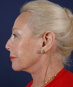 Blepharoplasty Patient 63866 Photo 2