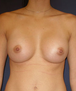 Breast Augmentation Patient 43374 Photo 2