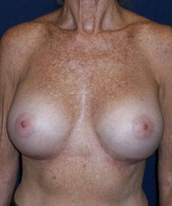 Breast Augmentation Patient 50449 Photo 2
