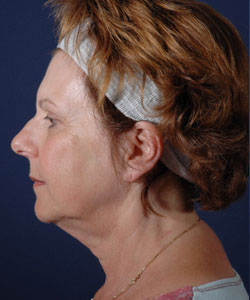 Facelift Patient 74234 Photo 3