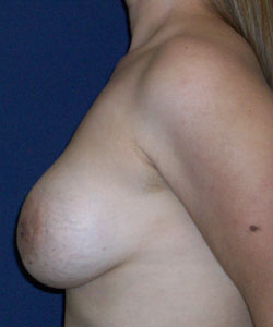 Breast Revision – (Breast Redo) Patient 13333 Photo 3