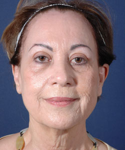 Facelift Patient 90501 Before Photo # 1