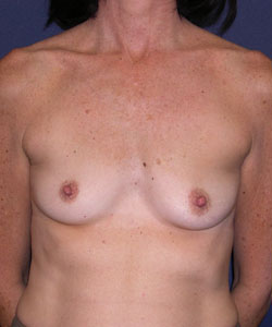 Breast Augmentation Patient 57793 Photo 1