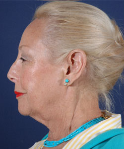 Blepharoplasty Patient 63866 Photo 1
