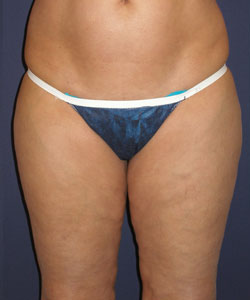 Liposuction Patient 10146 Photo 3