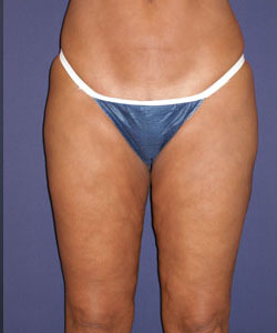 Liposuction Patient 10146 Photo 4