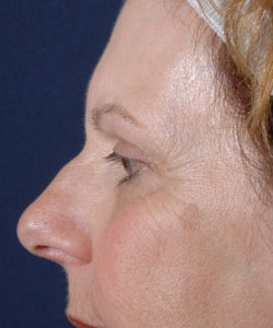 Blepharoplasty Patient 99194 Photo 3