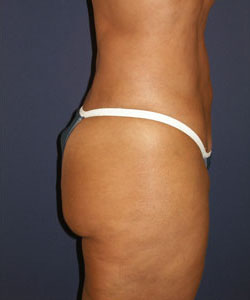 Liposuction Patient 10146 Photo 8