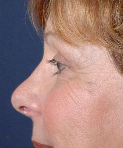 Blepharoplasty Patient 99194 Photo 4