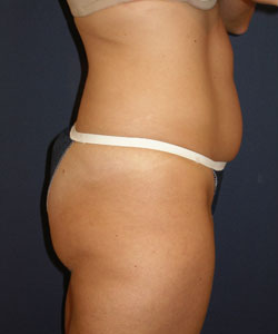 Abdominoplasty (Tummy Tuck) Patient 34855 Photo 1