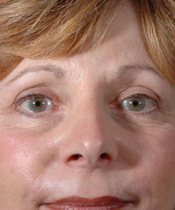 Blepharoplasty Patient 99194 After Photo # 2