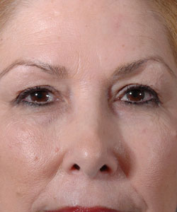 Blepharoplasty Patient 31992 Before Photo # 1