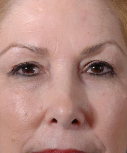 Blepharoplasty Patient 31992 Photo 1