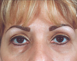 Blepharoplasty Patient 53831 Before Photo # 1