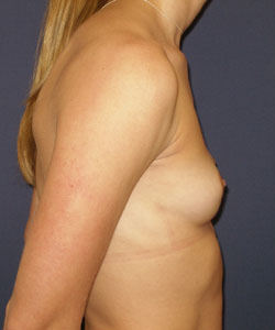 Breast Augmentation Patient 99006 Photo 3