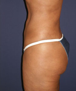 Liposuction Patient 10146 Photo 6