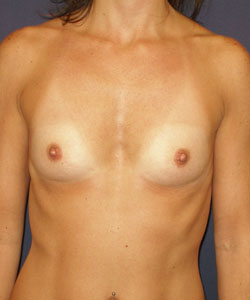 Breast Augmentation Patient 15787 After Photo # 2