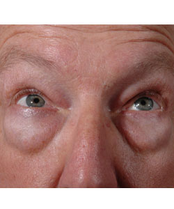 Blepharoplasty Patient 16727 Before Photo # 1