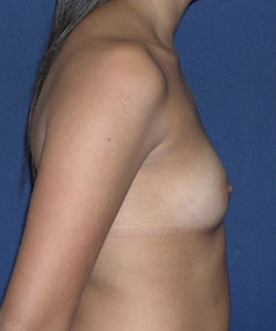 Breast Augmentation Patient 89770 Photo 3