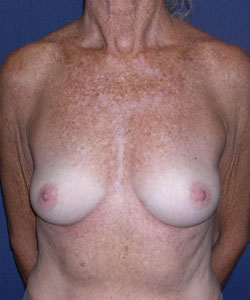 Breast Augmentation Patient 50449 Photo 1