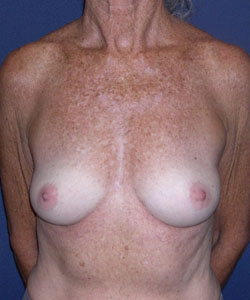 Breast Augmentation Patient 50449 Before Photo # 1