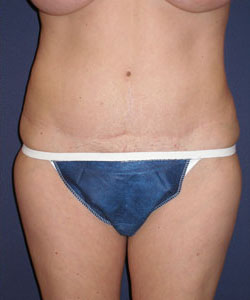 Abdominoplasty Patient 11649 After Photo # 2