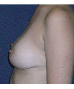 Breast Lift Patient 29101 Photo 4