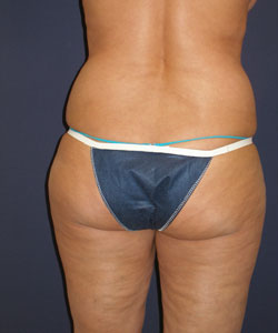 Liposuction Patient 10146 Before Photo # 1