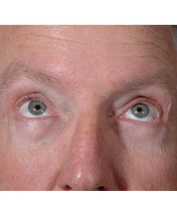Blepharoplasty Patient 16727 After Photo # 2