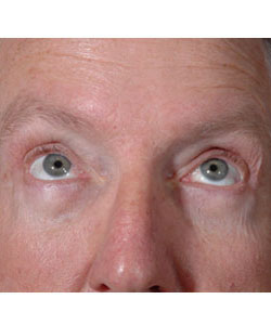 Blepharoplasty Patient 16727 Photo 2