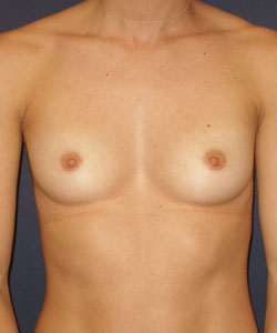 Breast Augmentation Patient 99006 Photo 1