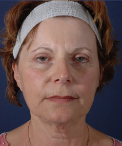 Facelift Patient 74234 Before Photo # 1