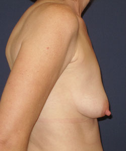 Breast Augmentation and Lift Patient 12580 Photo 3