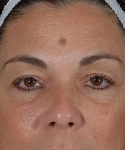 Blepharoplasty Patient 61736 Before Photo # 1