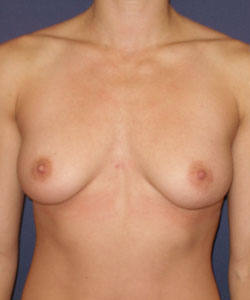 Breast Augmentation Patient 11073 Photo 1