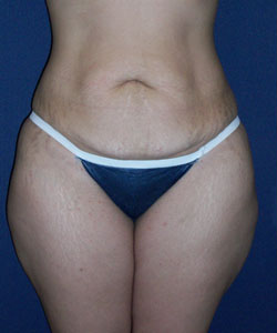 Abdominoplasty Patient 25869 Before Photo # 1